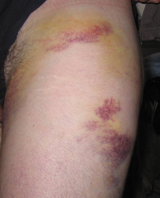 Bruised Leg