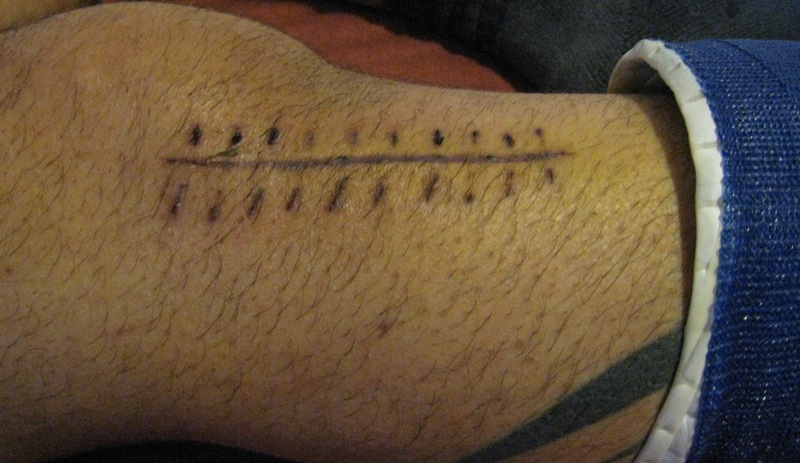 One for the ladies that like scars :)