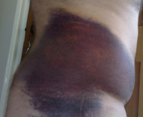 minor bruising.jpg