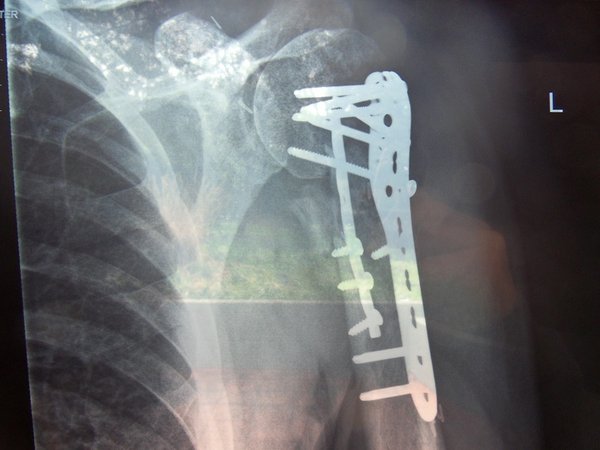 few screws too many....